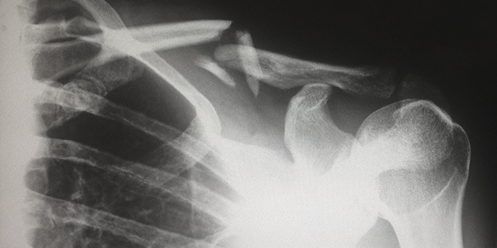 xray-showing-broken-shoulder-bone